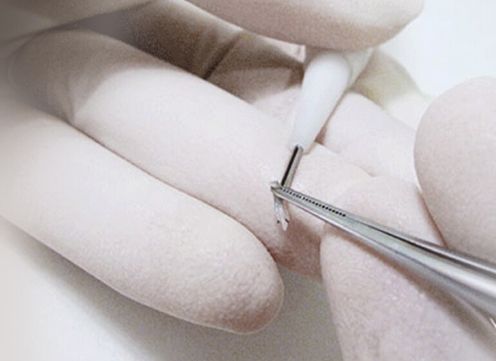  NHDT hair transplant implanter